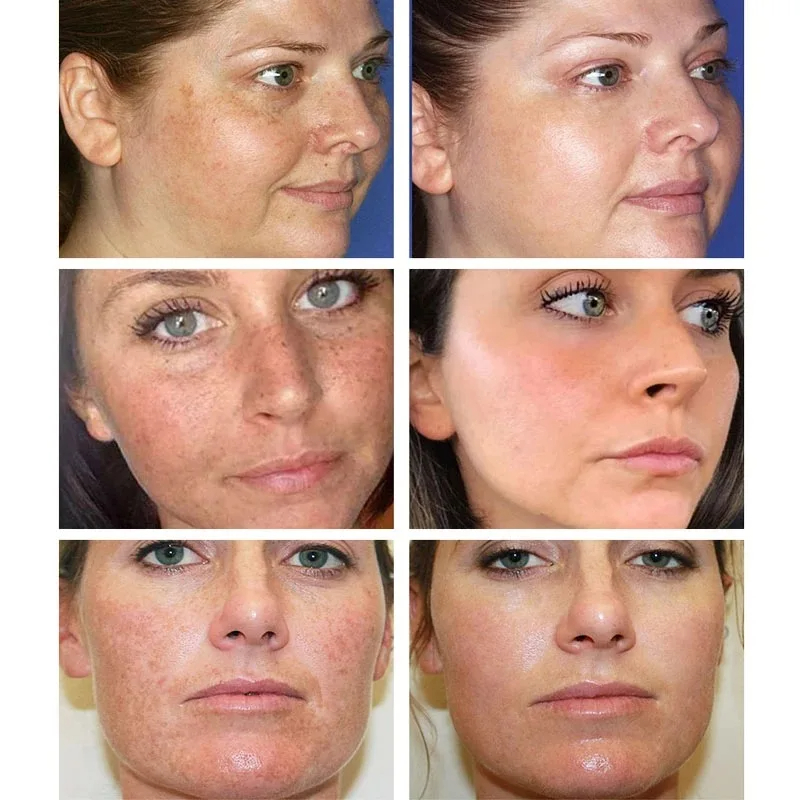 Whitening Freckle Cream Remove - Skincare Glowing ulasan dan harga